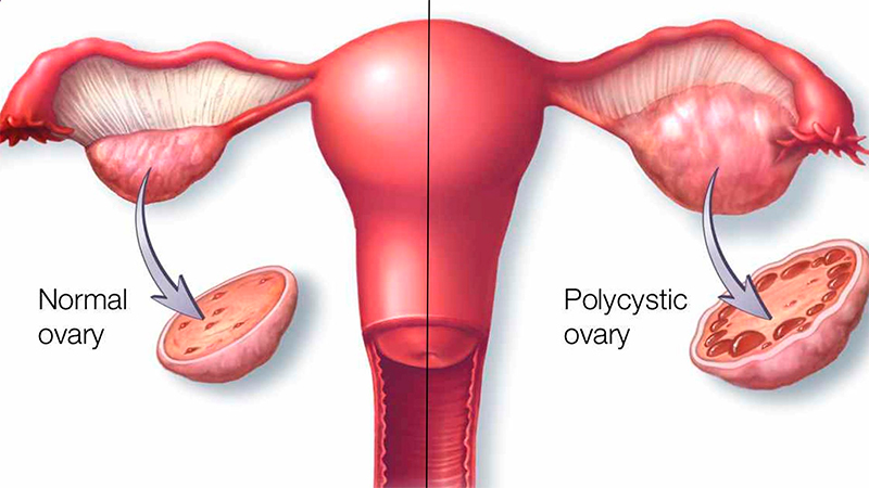 Ovarios poliquísticos Revisión ginecológica barata Barcelona